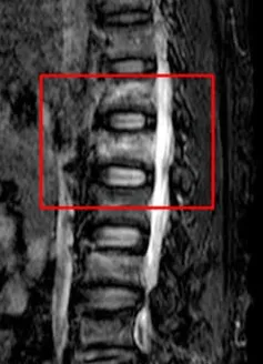 Cảnh báo chấn thương nặng do trèo cây hái trái cây mùa Hè