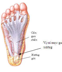 Không nên đi lại nhiều khi bị gai xương bàn chân