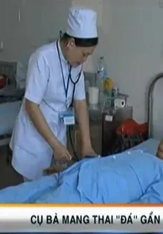 Hy hữu bà cụ mang thai “đá” gần 30 năm