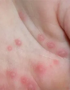 6 cách đơn giản phòng bệnh tay - chân - miệng cho trẻ 