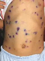 Cách phòng ngừa thủy đậu trong ngày hè