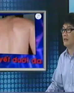 Sốc là biến chứng nặng trong sốt xuất huyết