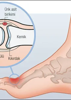 Phương pháp mới điều trị bệnh gút