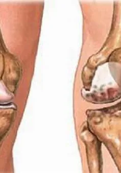 Sử dụng thuốc điều trị khớp đúng cách
