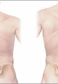 Phát hiện sớm chứng vẹo cột sống ở trẻ em