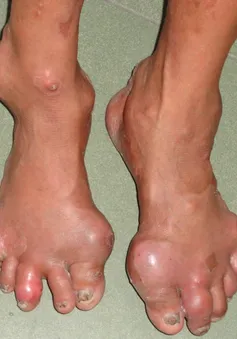 Bài thuốc điều trị hiệu quả bệnh Gout