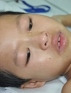 Tính mạng cậu bé dân tộc Sán Chỉ nguy kịch do khối u thân đốt sống ngực