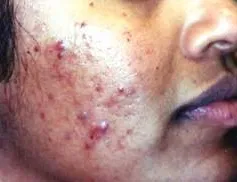 Cách điều trị mụn trứng cá 