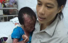 Hoàn cảnh đáng thương của bé trai 4 tuổi bị bỏng nặng