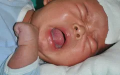 Xót thương bé 44 ngày tuổi bị bỏng than