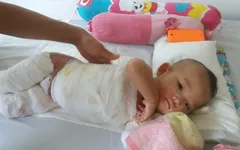 Thương cháu bé 11 tháng tuổi bị bỏng nước sôi nặng