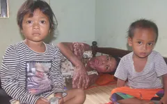 Số phận nghiệt ngã của thiếu phụ người Ê Đê bị biến dạng do bỏng xăng