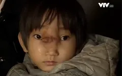 Bé gái có khối u lớn trên mặt khát khao được phẫu thuật