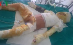 Bé trai 6 tuổi bị bỏng cồn toàn thân rất cần sự chia sẻ, giúp đỡ