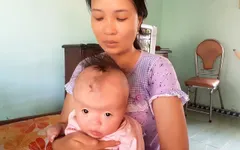 Thương bé 7 tháng tuổi mắc hội chứng Apert hiếm gặp