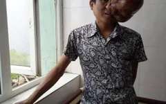 Khối u hơn 3kg xâm lấn gương mặt người đàn ông Xinh Mun