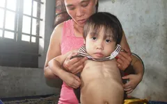 Thiếu 80 triệu đồng để thay khớp, bé gái 4 tuổi có nguy cơ bị bại liệt
