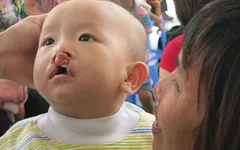 Phẫu thuật miễn phí cho trẻ dị tật khe hở môi vòm miệng