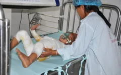 Ngã vào nồi cám lợn, bé 4 tuổi nguy kịch tính mạng