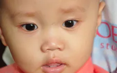 Sự sống mong manh của bé 13 tháng tuổi dân tộc Tày bị u não