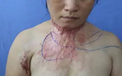Gia cảnh khốn cùng của người phụ nữ bị di chứng bỏng