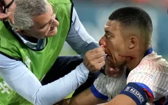 Mbappé đang gặp khó khăn với việc thay đổi mặt nạ liên tục trong các trận đấu