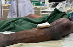 Nguy kịch vì viêm mô bào sau khi bị gai đâm vào chân ở đầm tôm