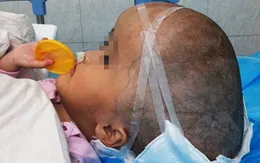 Trung Quốc: Bé gái bị não úng thủy đầu tiên trên thế giới được thay hộp sọ nhân tạo