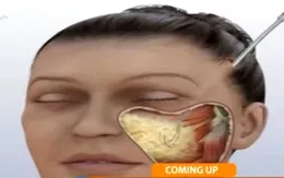 Có nên căng da mặt?