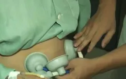 Tiến bộ mới chẩn đoán, điều trị rối loạn chức năng đại tiện