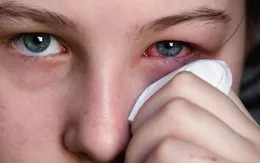 Mắt bị đỏ khi bơi là do... nước tiểu trong bể