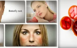 Một số lưu ý trong điều trị bệnh Lupus ban đỏ hệ thống