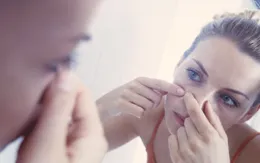 Bí kíp phòng ngừa mụn trứng cá