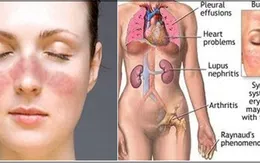 Bệnh nhân Lupus ban đỏ đa phần là nữ