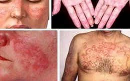 Nhận diện căn bệnh Lupus ban đỏ hệ thống