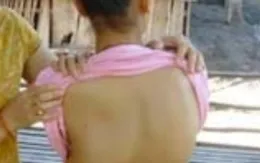 Cách phòng và điều trị cong vẹo cột sống ở trẻ nhỏ