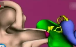 Nguyên nhân và cách điều trị bệnh nghễnh ngãng