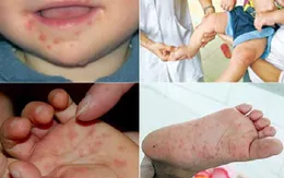 Hơn 70 ca tử vong do dịch tay chân miệng từ đầu năm đến nay