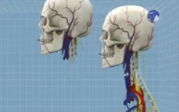 Phẫu thuật cấy ghép đầu người - Đột phá mới của y học?