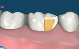 Cần lưu ý chế độ ăn uống và khám định kỳ khi bọc răng sứ