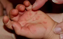 Hà Nội: Xuất hiện nhiều ổ dịch tay chân miệng