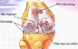 Ứng dụng tế bào gốc trong điều trị thoái hóa khớp gối