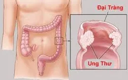 Phương pháp mới tiêu diệt tế bào ung thư đại trực tràng