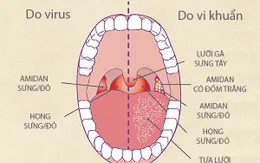 Kháng sinh không phải phao cứu sinh với bệnh viêm họng virus