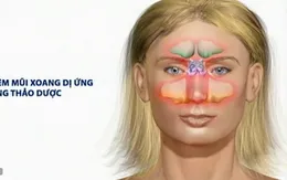 7 lưu ý đối với bệnh viêm mũi xoang dị ứng