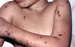 Những điều cần biết về bệnh viêm màng não mô cầu
