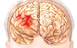 Nguy cơ tử vong bởi dị dạng mạch máu