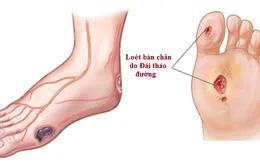 Biến chứng thần kinh ở người đái tháo đường