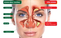 Bệnh viêm xoang - Nỗi lo không của riêng ai