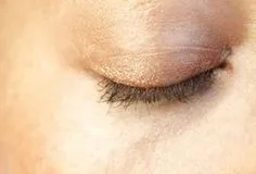 Hở mi mắt: Nguy cơ mắc phải và cách điều trị